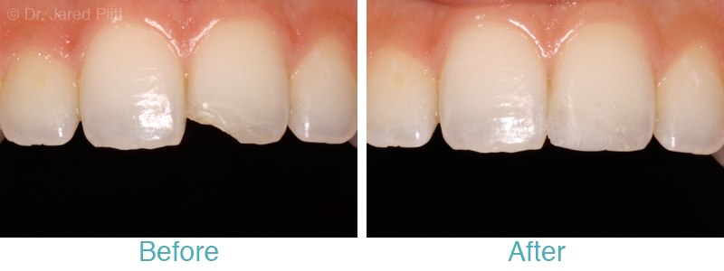 Miami Beach Cosmetic Dentistry Services White Fillings Porcelain 